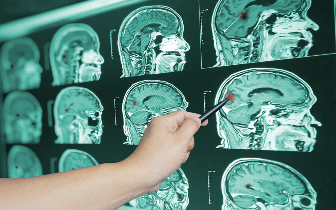 What is a Mild Traumatic Brain Injury and How Can a Chiropractor Help?